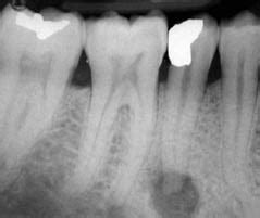 1.4: Chronic periapical periodontitis with an extraoral sinus | Pocket ...