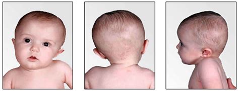 Congenital torticollis causes, symptoms, diagnosis, treatment & exercises