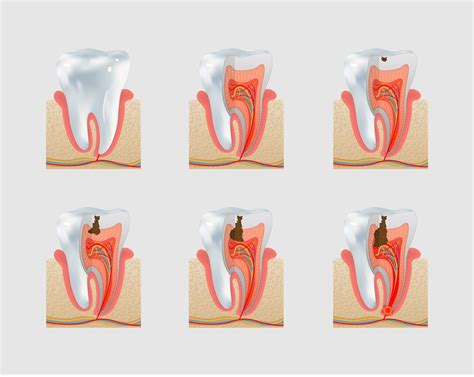 Dentist Showing A Cavity With A Mouth Mirror - HooDoo Wallpaper