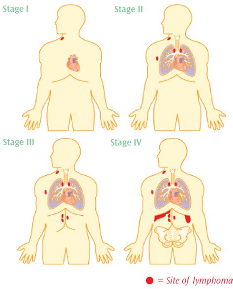 Non-Hodgkin Lymphoma Staging - Understand the Different Stages