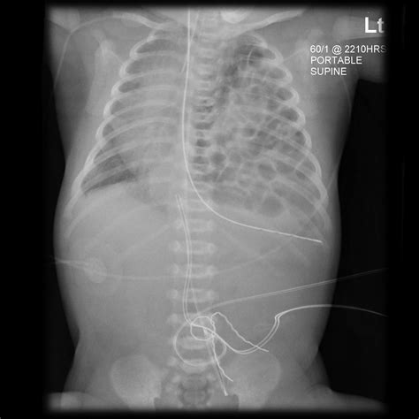 Congenital diaphragmatic hernia chest x ray - wikidoc