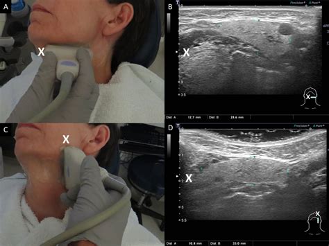 Salivary ultrasound standardized diagnostic approach and report | Iowa ...