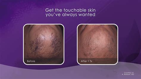 Laser Hair Removal Treatment | Laser Hair Removal Near Me