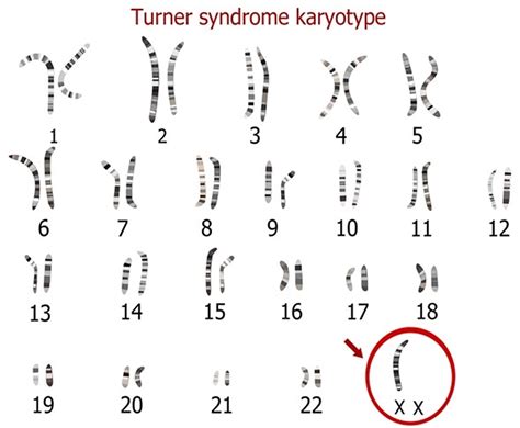 Turner Syndrome - Causes, Symptoms, Life Expectancy, Treatment