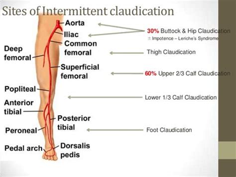 Richard Whelan ~ Medical Herbalist ~ Intermittent claudication