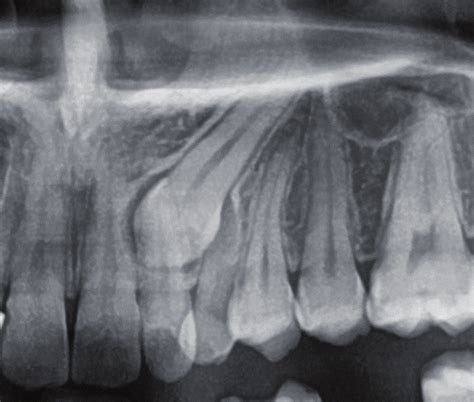 Radiograph of dentigerous cyst in maxillary impacted canine. | Download ...