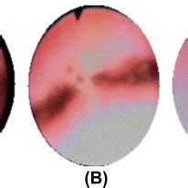 Shapes of epiglottis (A): flat epiglottis; (B): omega shaped ...