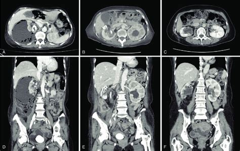 (A, D) Abdominal computed tomography (CT) scans on admission ...