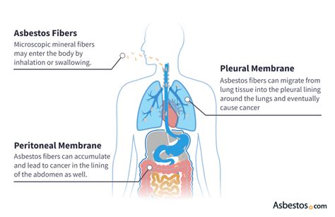 Causes of Mesothelioma: Asbestos Exposure and Risk Factors