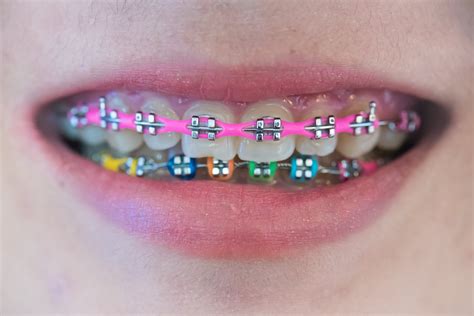 What Color of Braces Should You Wear | Shinagawa PH