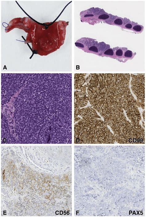 Gross and Histology of Ewing Sarcoma. (A) 1.7 Â 1.3 Â 0.3 cm piece of ...