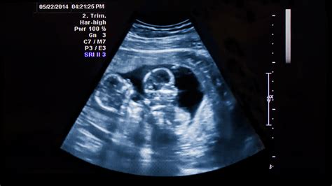 20 week ultrasound with twins