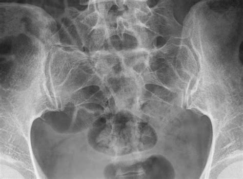 Fractured Sacrum - Fracture Treatment