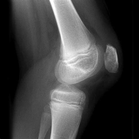 Chondromalacia patella | Radiology Case | Radiopaedia.org