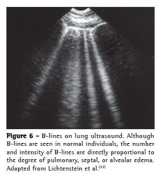 Lung Ultrasound – Pocket ICU