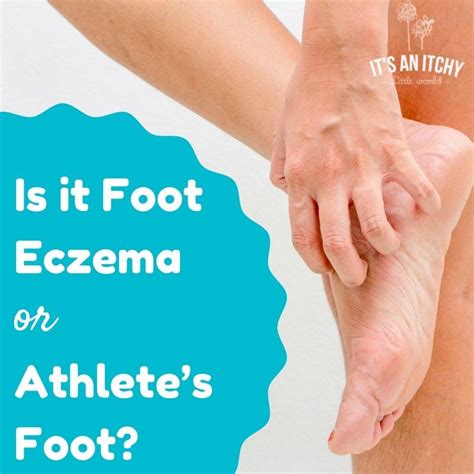 Is it Foot Eczema or Athlete’s Foot? | Natural cough remedies, Herbal ...