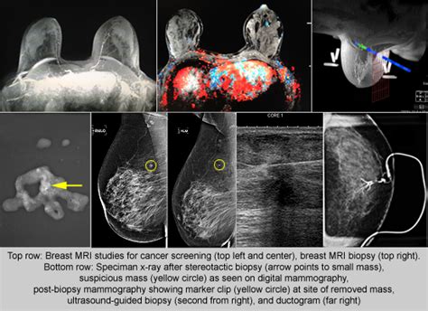 Diagnostic Mammogram Procedure