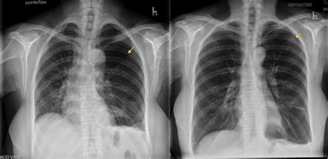 Pneumothorax – expiration - Radiology at St. Vincent's University Hospital