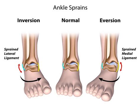 Understanding Ankle Sprains: Causes, Symptoms, & Recovery