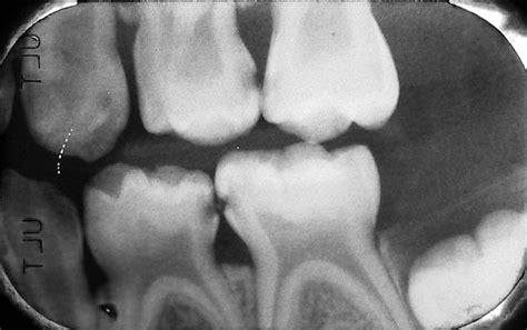 Clinical Cases | PDG Dental | Pediatric Dentistry & Orthodontics