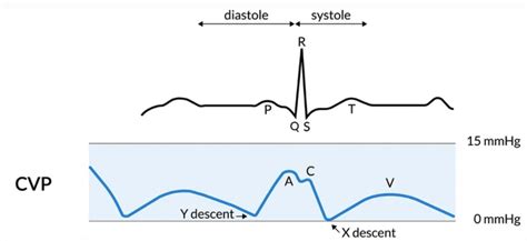 Abnormal Cvp Waveform