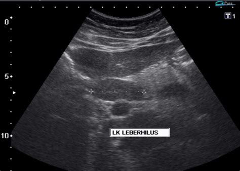 Splenic marginal zone lymphoma ultrasound - wikidoc