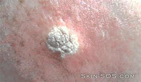 Home Remes For Seborrheic Keratosis - Homemade Ftempo