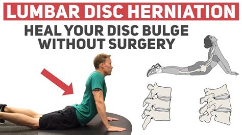 How to Heal Your Disc Herniation Without Surgery - YouTube