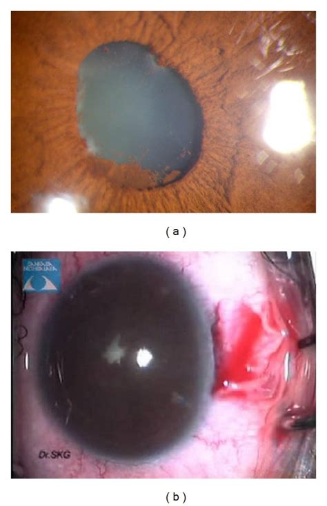 (a) Showing the eye with synechiae at papillary border, pigment ...