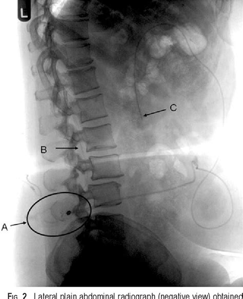 Figure 2 from Use of lumboperitoneal shunts with the Strata NSC valve ...