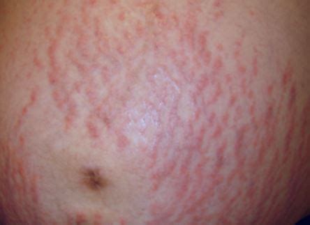 Puppp Rash - Pictures, Symptoms, Causes, Treatment, What is