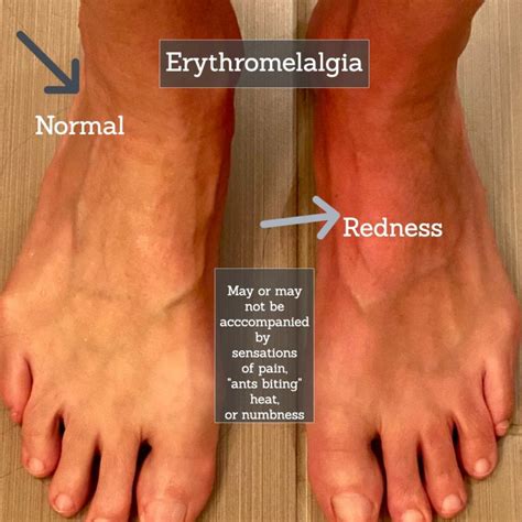 Small Fiber Neuropathy Causes and Treatment - Suzy Cohen, RPh offers ...