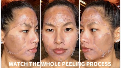 WATCH WHAT HAPPENS AFTER YOU GET A PEEL ( 7 DAY PEEL PROCESS) - YouTube