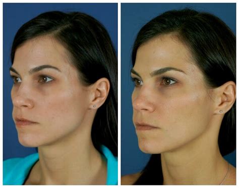 How I Found Relief from Jaw Clenching with Botox Injections