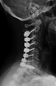 life after three-level posterior cervical fusion surgery - Mila Hathaway