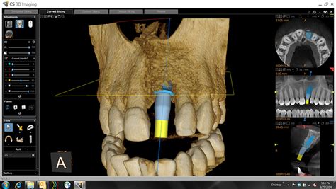 How Your Oral Surgeon Uses Cone Beam CT for Less Invasive Dental ...