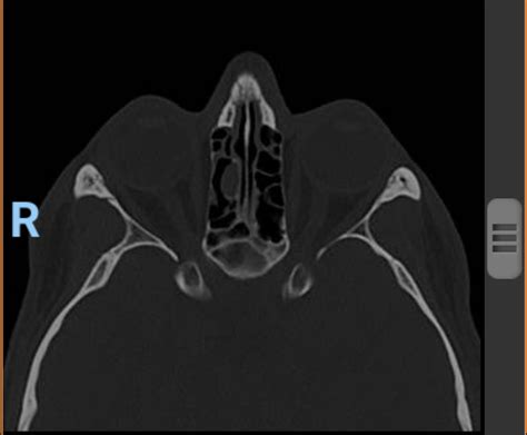 CT Scan. Opacified ethmoid cell. Ignore, inflammation or infection ...