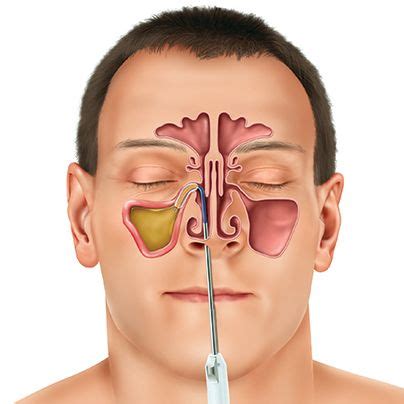 sinus balloon diagram | Sağlık ve fitness, Sağlık, Tıbbi