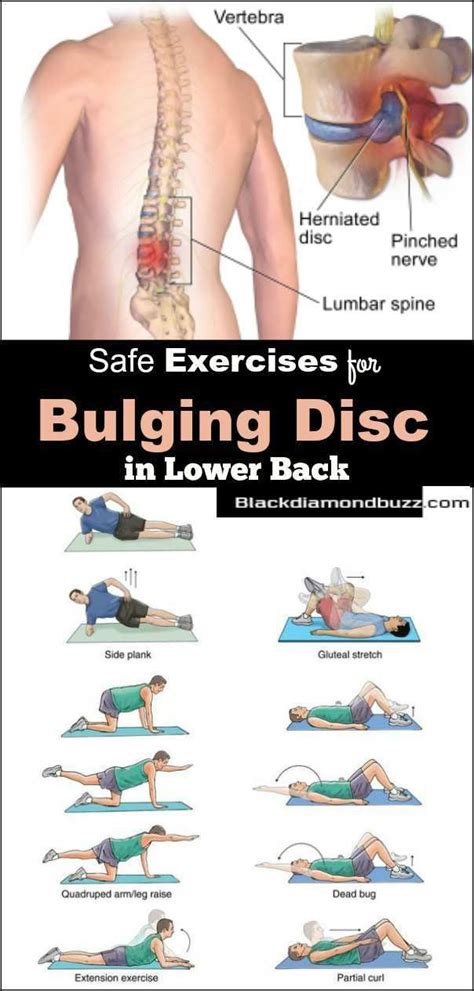 Exercises for bulging disc in lower back | Bulging disc exercises ...