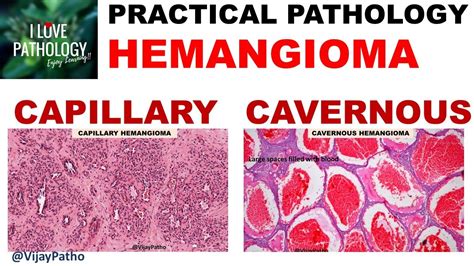 Capillary Hemangioma