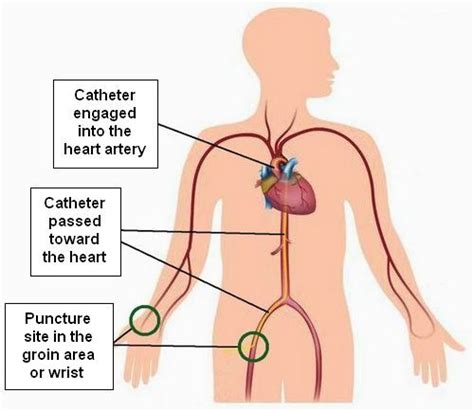 Coronary Angiogram — Golden Shutter Films