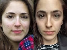 accutane before and after 3 | Public Health