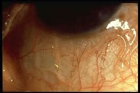 loiasis disease