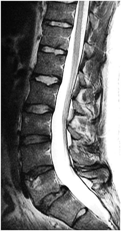 Herniated Lumbar Disc Mri