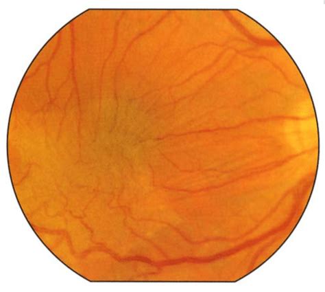 Symptoms, Causes, and Treatments of Epiretinal Membrane | Delaware Valley