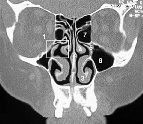 Coronal CT scan of nasal cavity at the osteomeatal complex. (1 ...