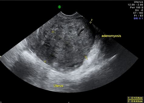 Adenomyoma Ultrasound