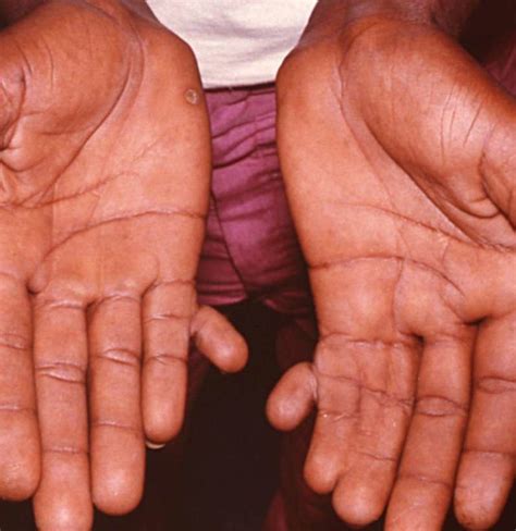 Polydactyly: Symptoms, causes, and treatments