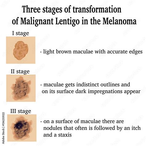 Three stages of transformation of Malignant Lentigo in the Melanoma ...