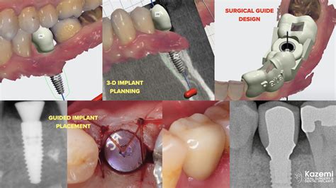 Peri-implantitis bone loss dental implant bone graft kazemi oral ...